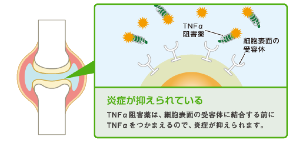 TNFα阻害薬が炎症を抑えるしくみ